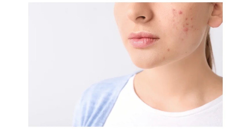 ¿Qué es el acné ?