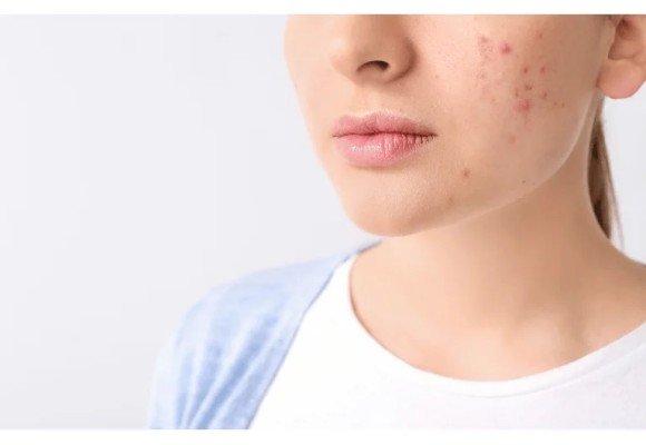 ¿Qué es el acné ?